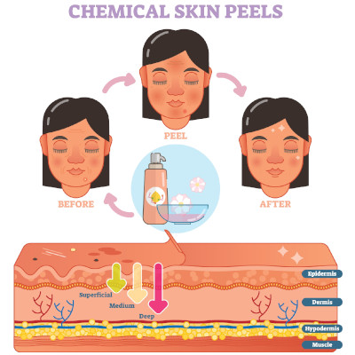 peelingi chemiczne na blizny po trądziku